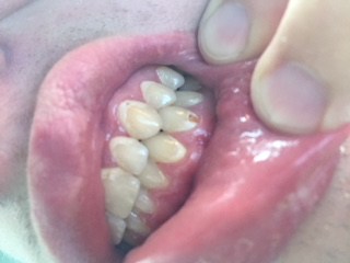 Brown spots on teeth pictures